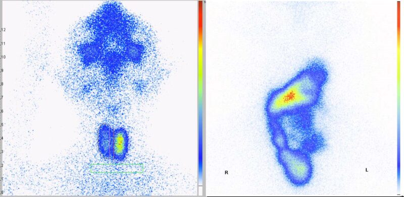 Abb2 Adenom vs Karzinom