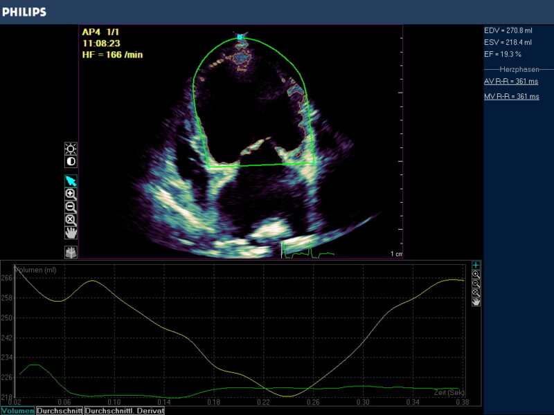 Abb 3 niedrige EF bei BERNHARDINER