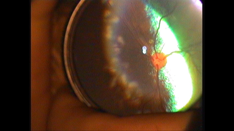 HOFF Laser Netzhautp OP