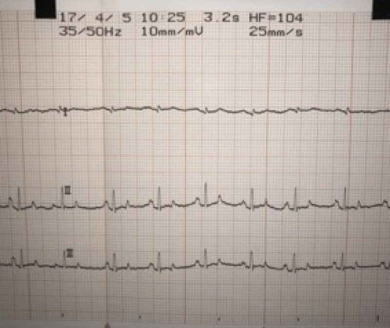 Stock4 Ekg Sinusrhythmus