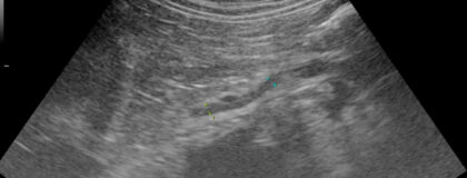 Ultraschall Nebenniere