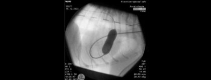 W570 Druckbelastende Erkrankungen des Herzens 1